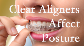 Clear aligners influence posture which Oxford chiropractic helps.