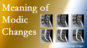 Satterwhite Chiropractic sees many back pain and neck pain patients who bring their MRIs with them to the office. Modic changes are often seen. 