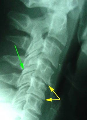 disc degeneration treated at Satterwhite Chiropractic