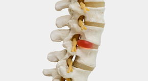 Oxford chiropractic conservative care helps even huge disc herniations go away