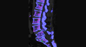 Satterwhite Chiropractic is aware that inflammatory spinal gout is a differential diagnosis to consider for patients who present with back pain and other spine related symptoms.