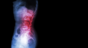 Oxford Chiropractic Care of Spondylolisthesis 