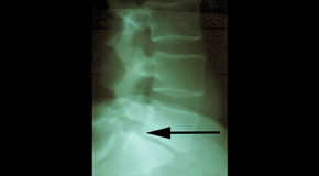 Oxford spondylolisthesis 