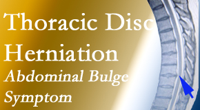 Satterwhite Chiropractic cares for thoracic disc herniation that for some patients prompts abdominal pain.
