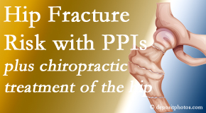 Satterwhite Chiropractic shares new research describing higher risk of hip fracture with proton pump inhibitor use. 