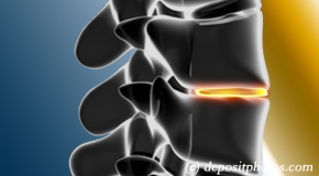 Oxford degenerative spinal changes 