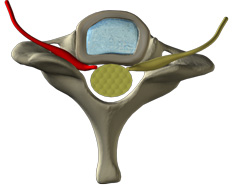 Cervical spine disc herniation