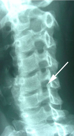 cervical spine minor stenosis