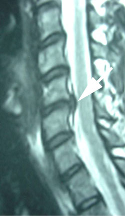 cervical instability