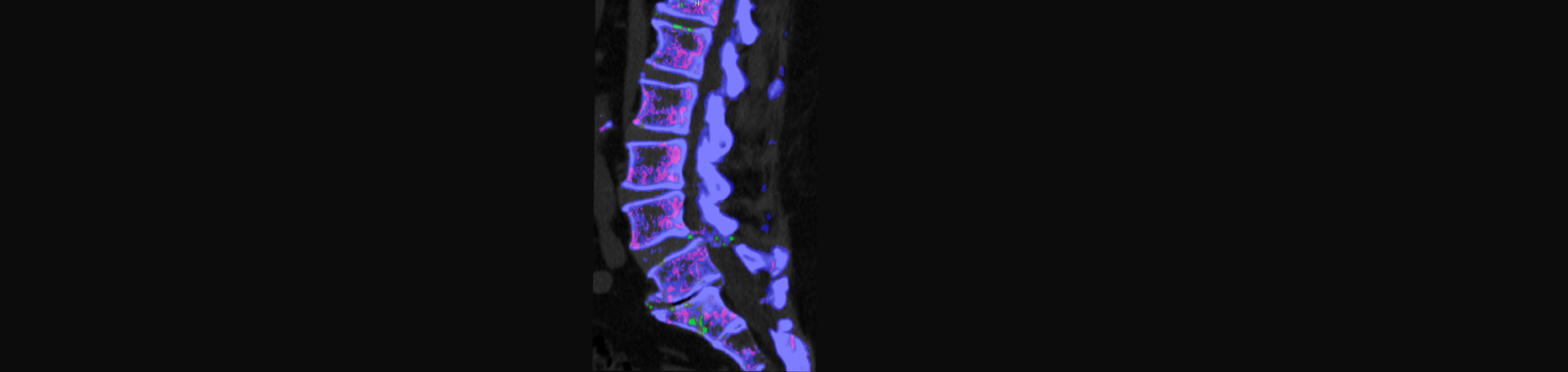 Satterwhite Chiropractic is aware that inflammatory spinal gout is a differential diagnosis to consider for patients who present with back pain and other spine related symptoms.