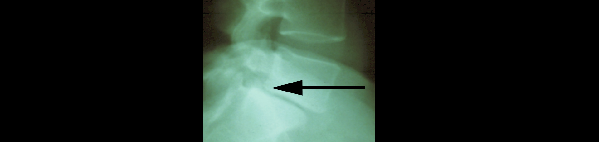 Oxford spondylolisthesis