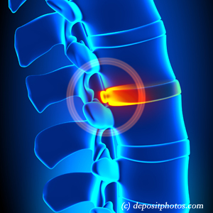 image of lumbar Oxford disc herniation