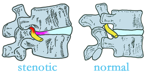 Oxford stenotic and normal spinal discs